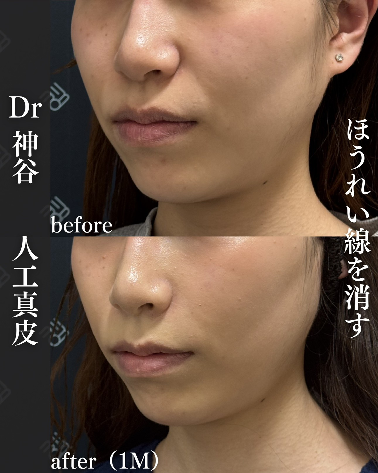 人工真皮ー症例写真