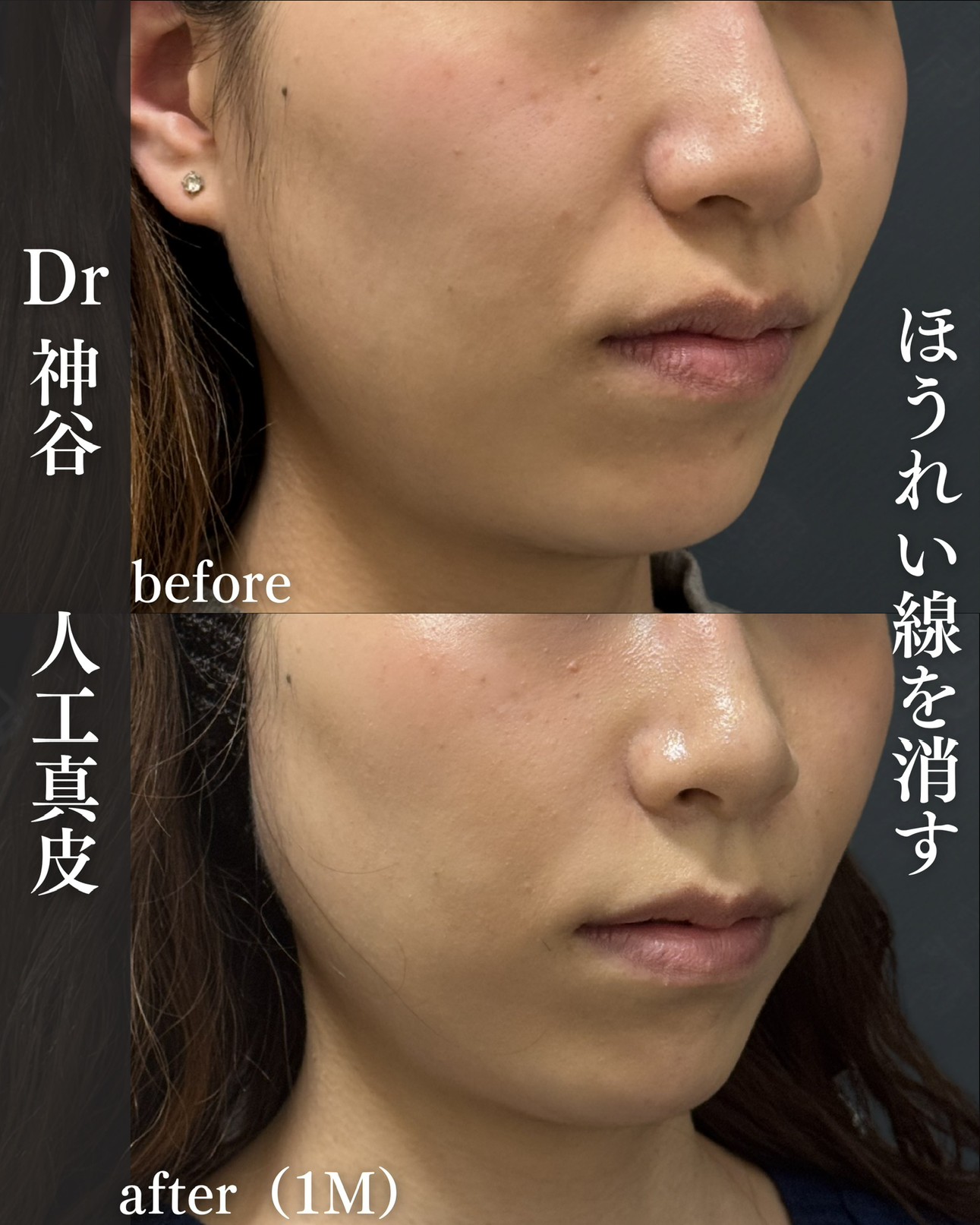 人工真皮ー症例写真