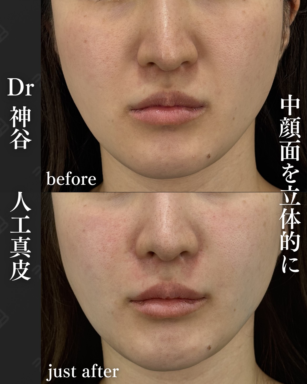 人工真皮ー症例写真