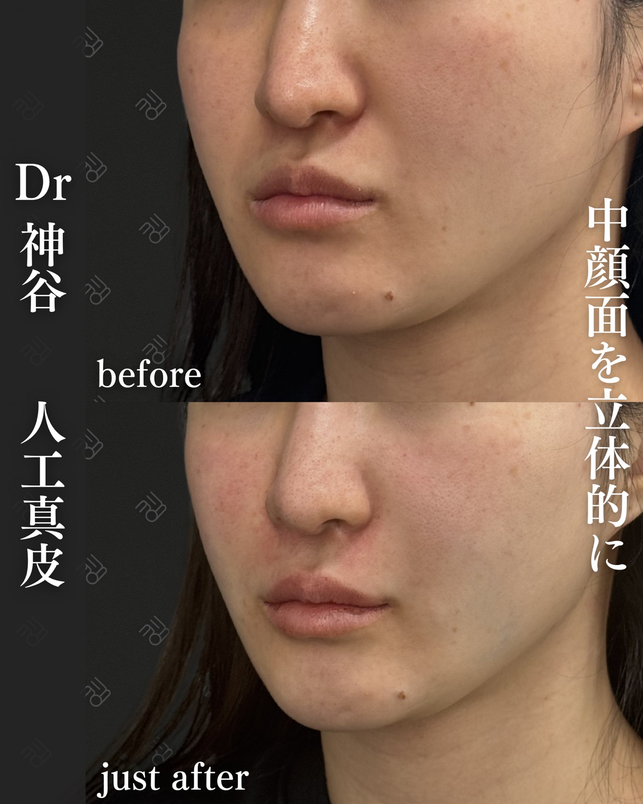 人工真皮ー症例写真