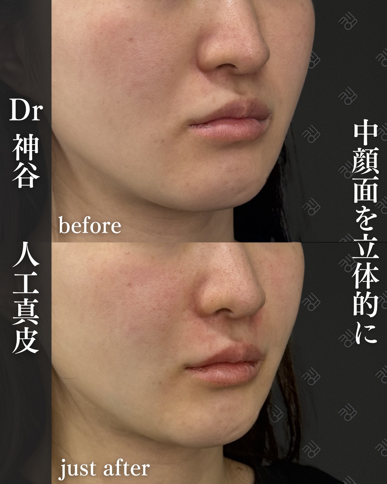 人工真皮ー症例写真