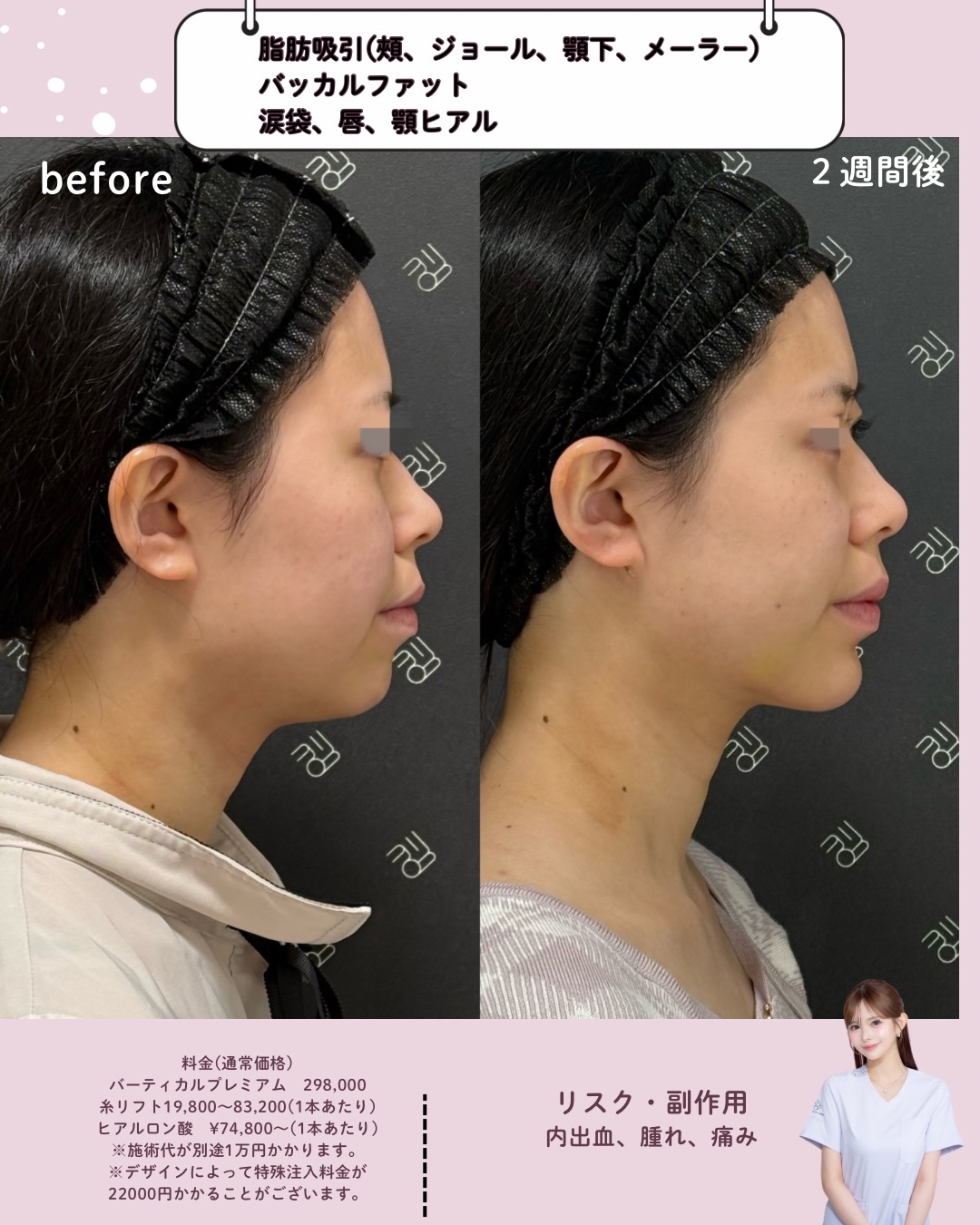 脂肪吸引×バッカルファット除去×ヒアルロン酸