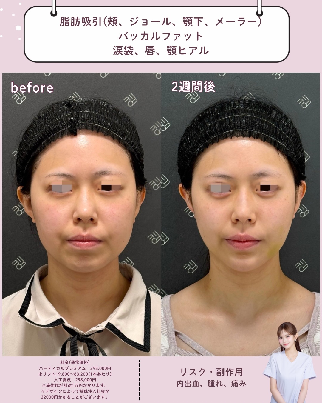 脂肪吸引×バッカルファット除去×ヒアルロン酸