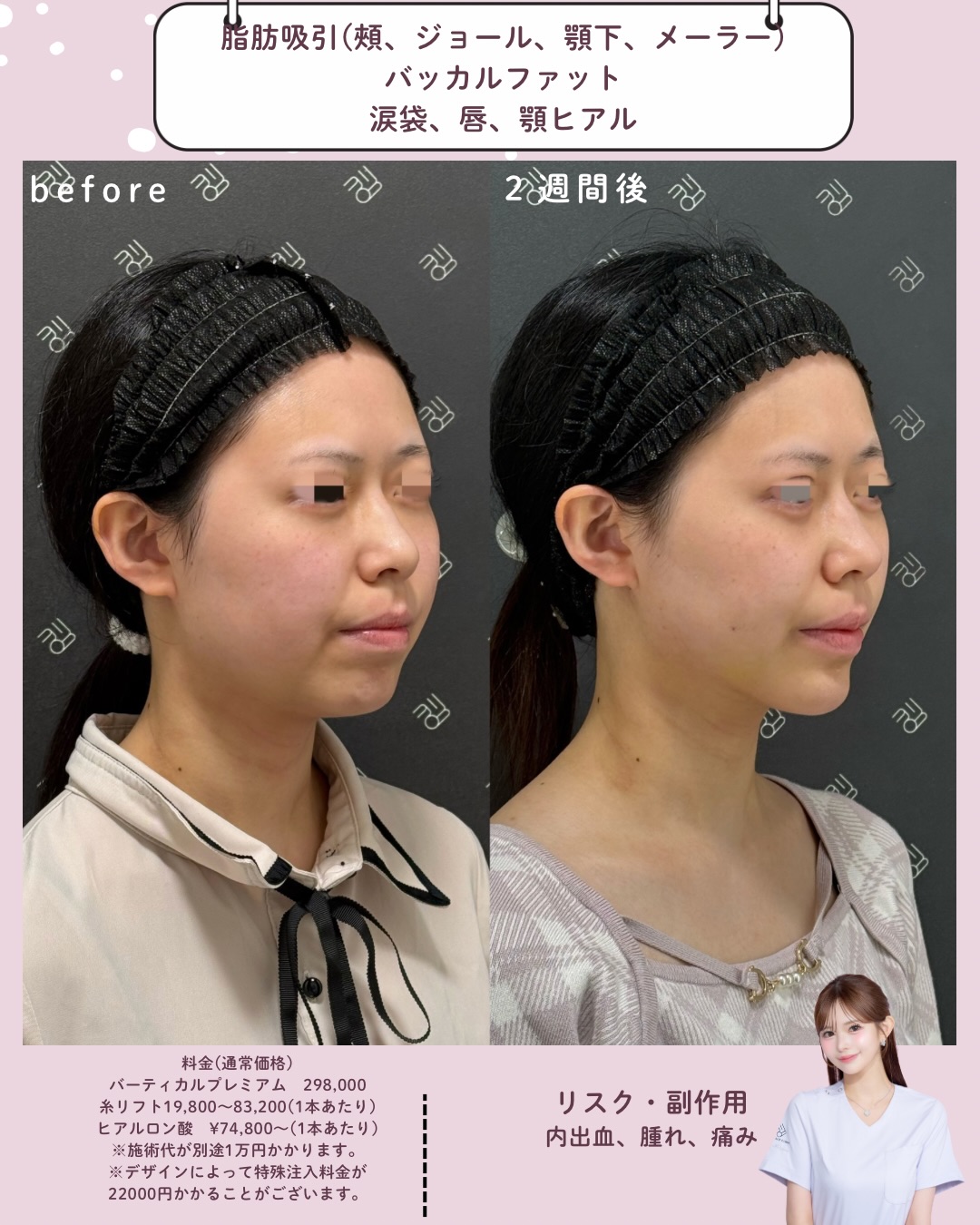 脂肪吸引×バッカルファット除去×ヒアルロン酸