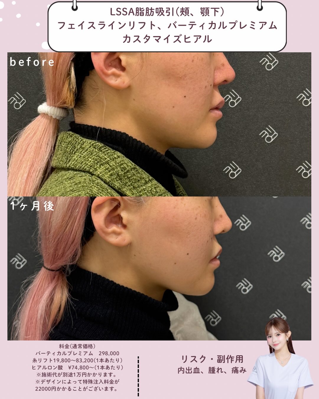 LSSA脂肪吸引×フェイスラインリフト×バーティカルリフト×カスタマイズヒアル