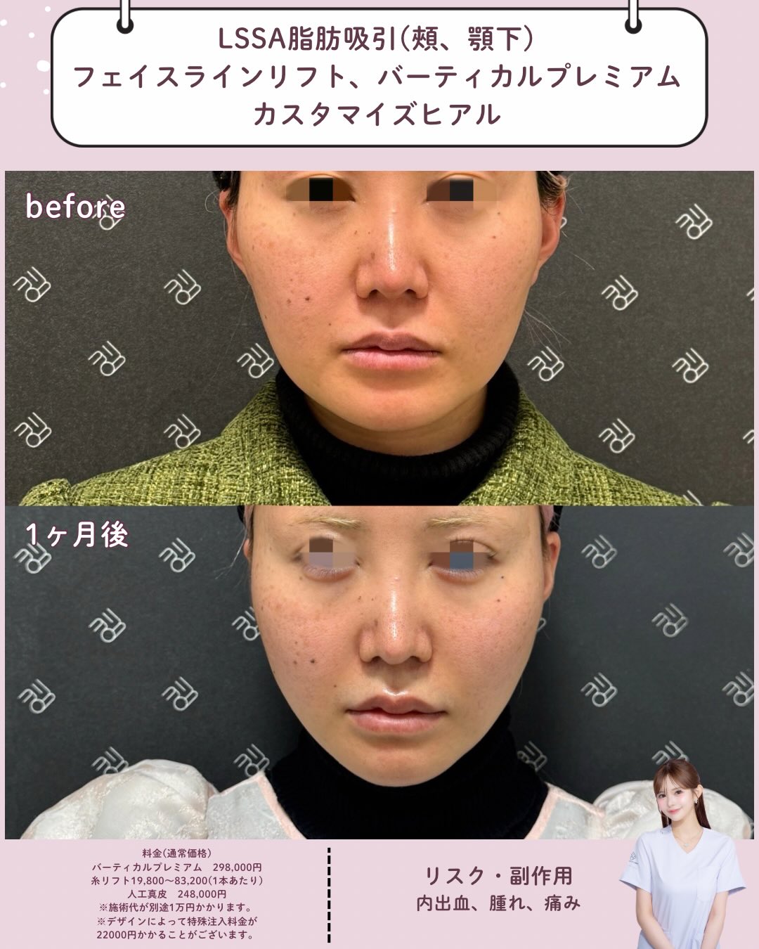 LSSA脂肪吸引×フェイスラインリフト×バーティカルリフト×カスタマイズヒアル