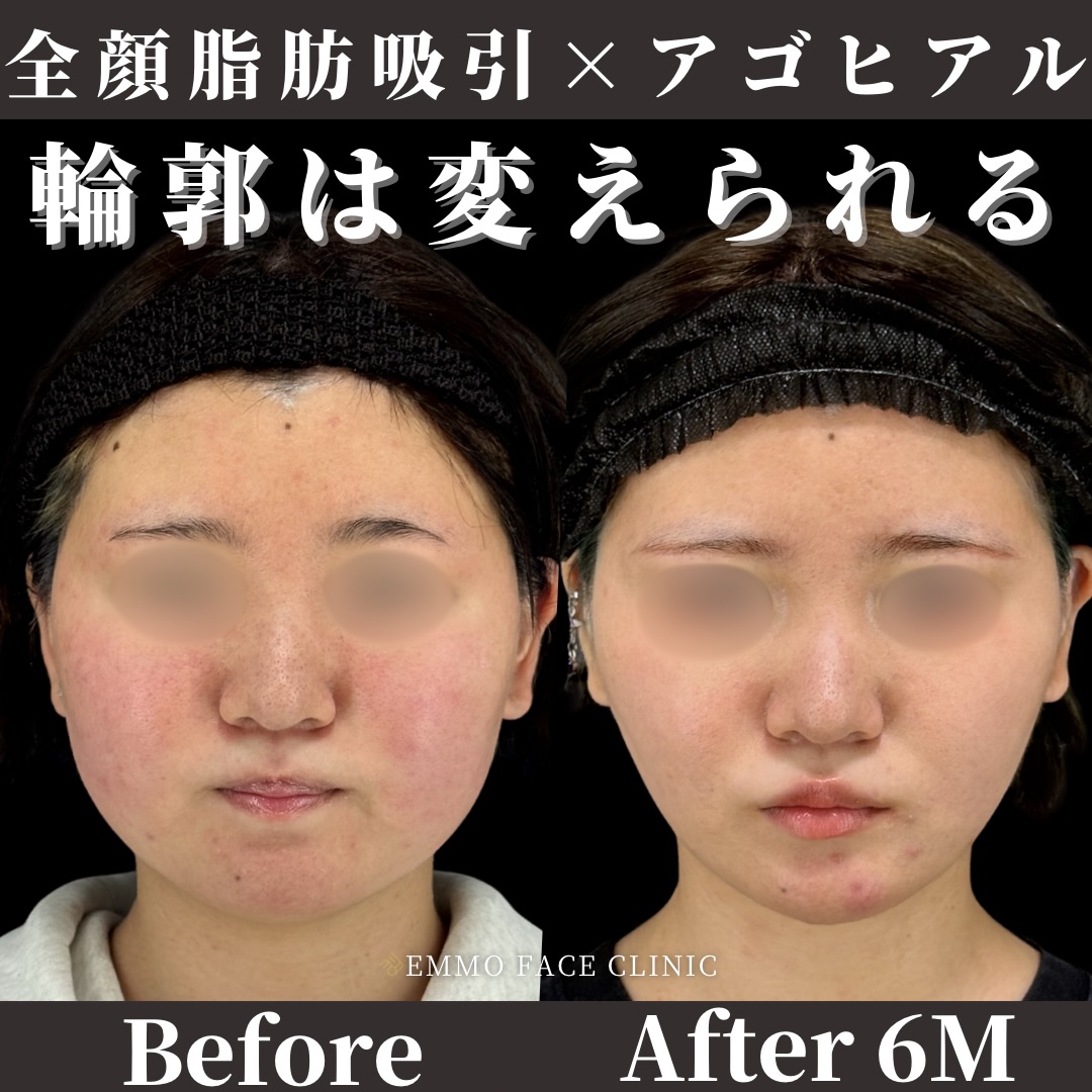 全顔脂肪吸引×顎ヒアルロン酸