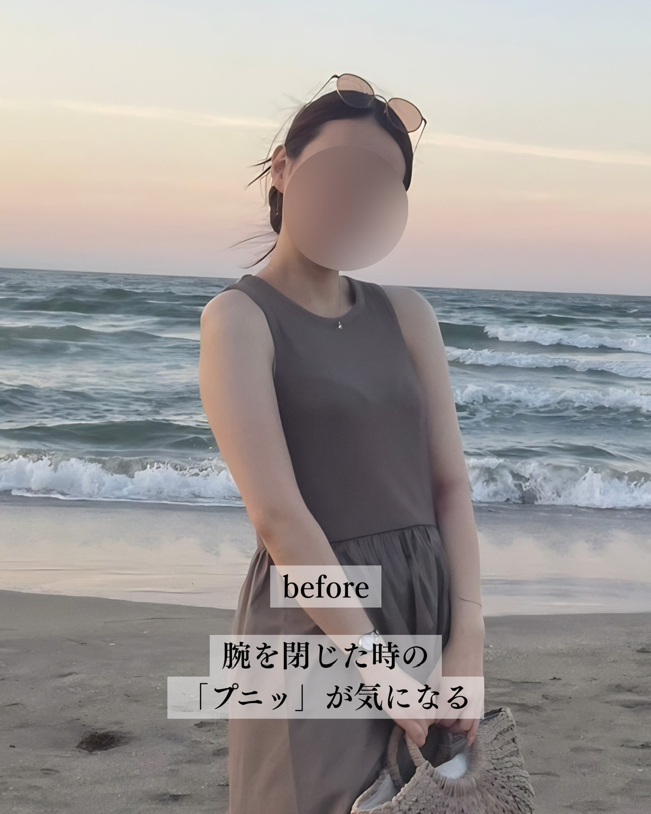 二の腕脂肪吸引ー症例写真