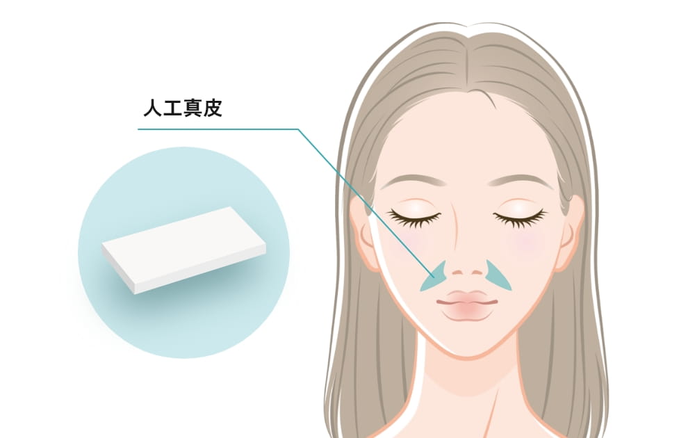 顔のほうれい線部分に挿入される人工真皮