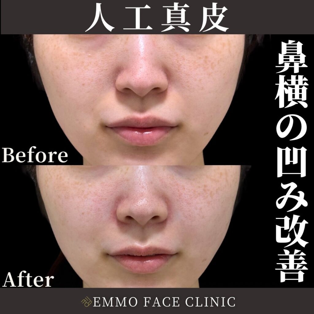 人工真皮で鼻横の凹みが改善された術前術後の比較