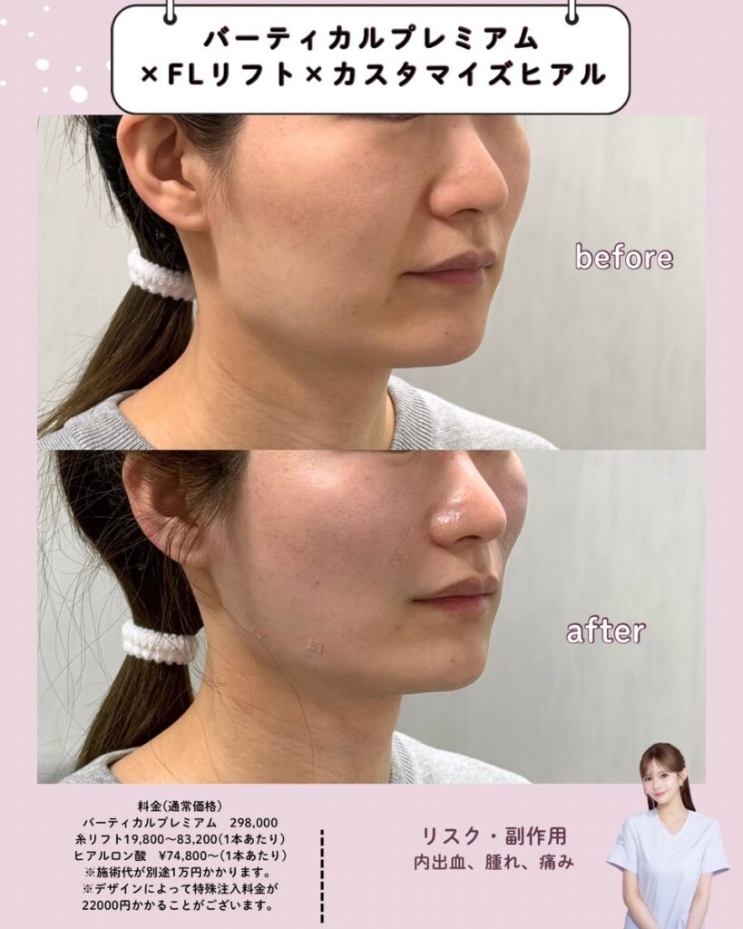 施術前後の女性の顔と首周りの比較
