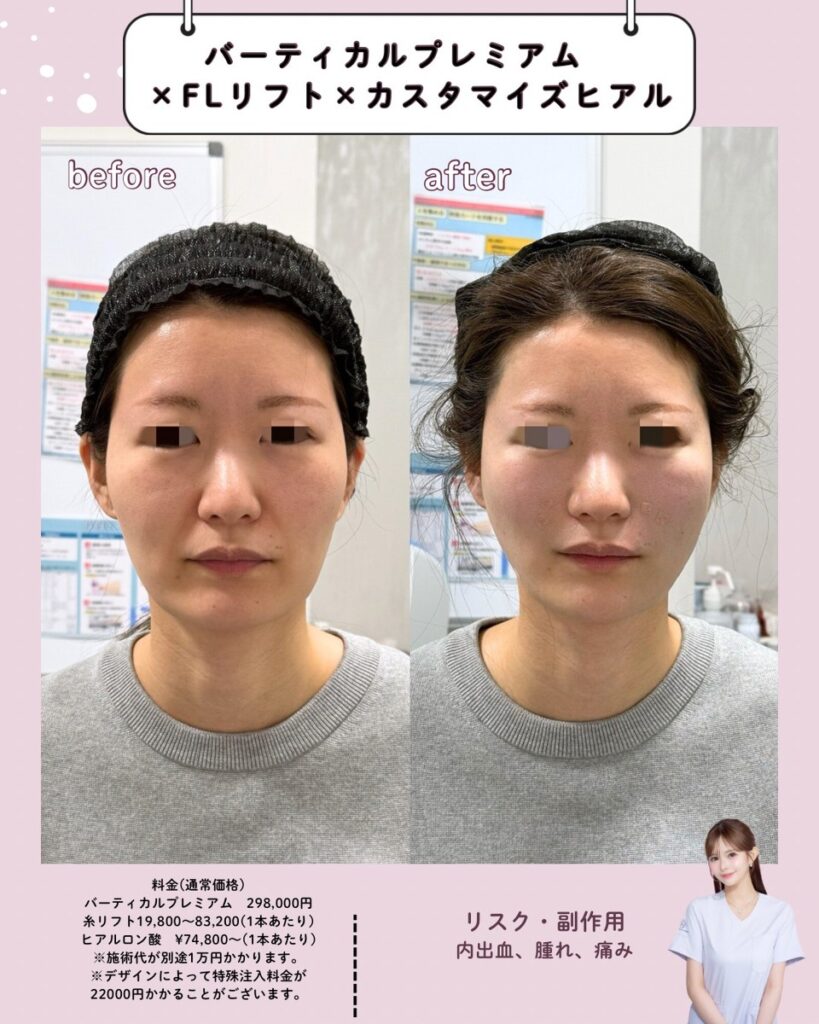 施術前後の女性の顔比較