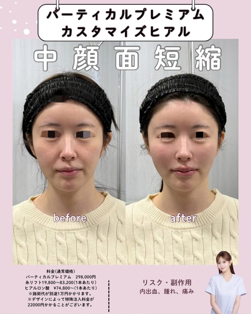 ヒアルロン酸注入とバーディカルリフトプレミアムの症例