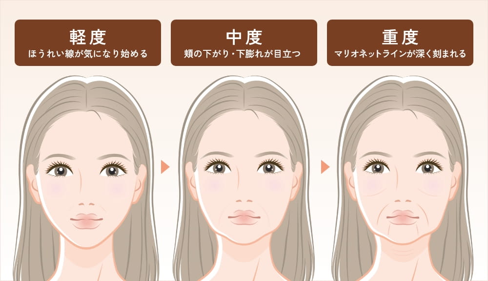 顔のたるみとシワの進行度合いを示す女性3人のイラスト