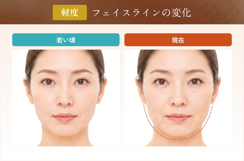 軽度のたるみやほうれい線の比較