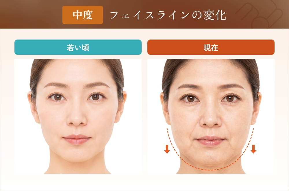 中度のたるみやほうれい線の比較