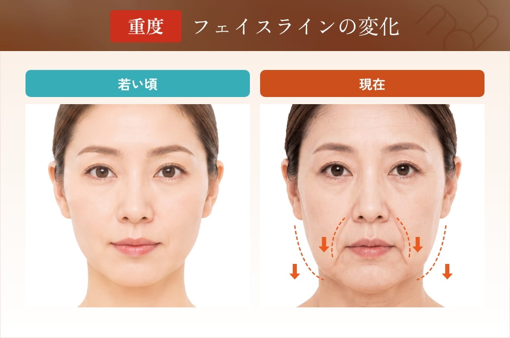 重度のたるみやほうれい線の比較