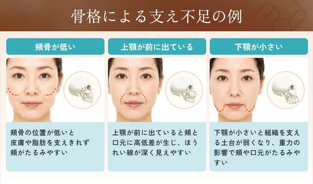 顔の骨格による頬や口元のたるみ例