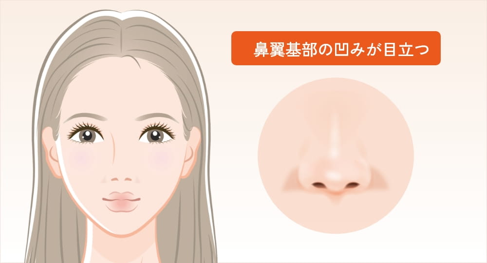 女性の顔と鼻翼基部の凹みが目立つ鼻のクローズアップ
