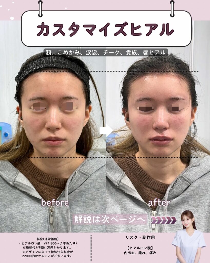 ヒアルロン酸注入のビフォーアフター