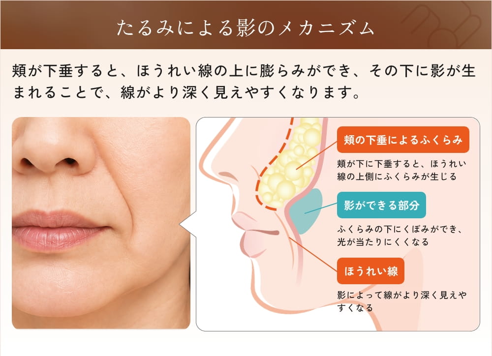 たるみによる影のメカニズム図と女性の顔