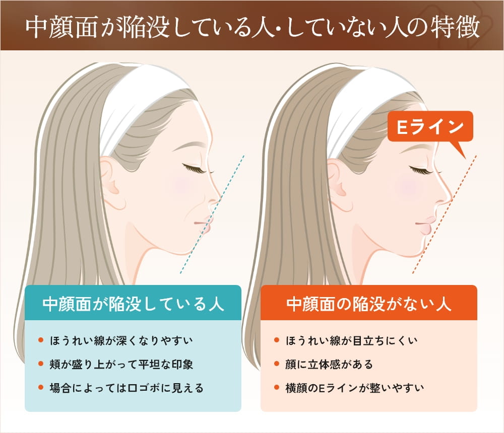 中顔面が陥没している人としていない人の比較