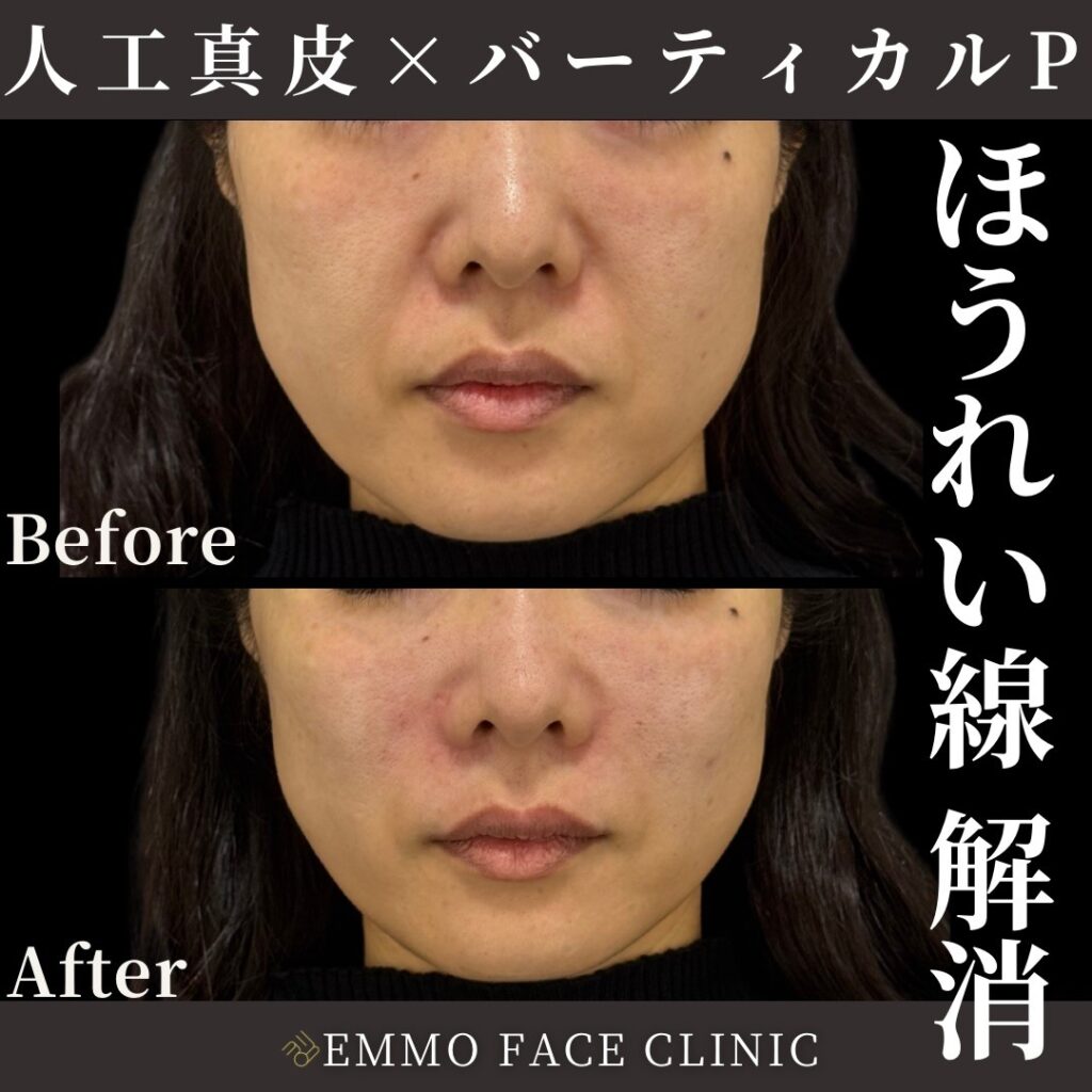 人工真皮とバーティカルリフトプレミアムのビフォーアフター