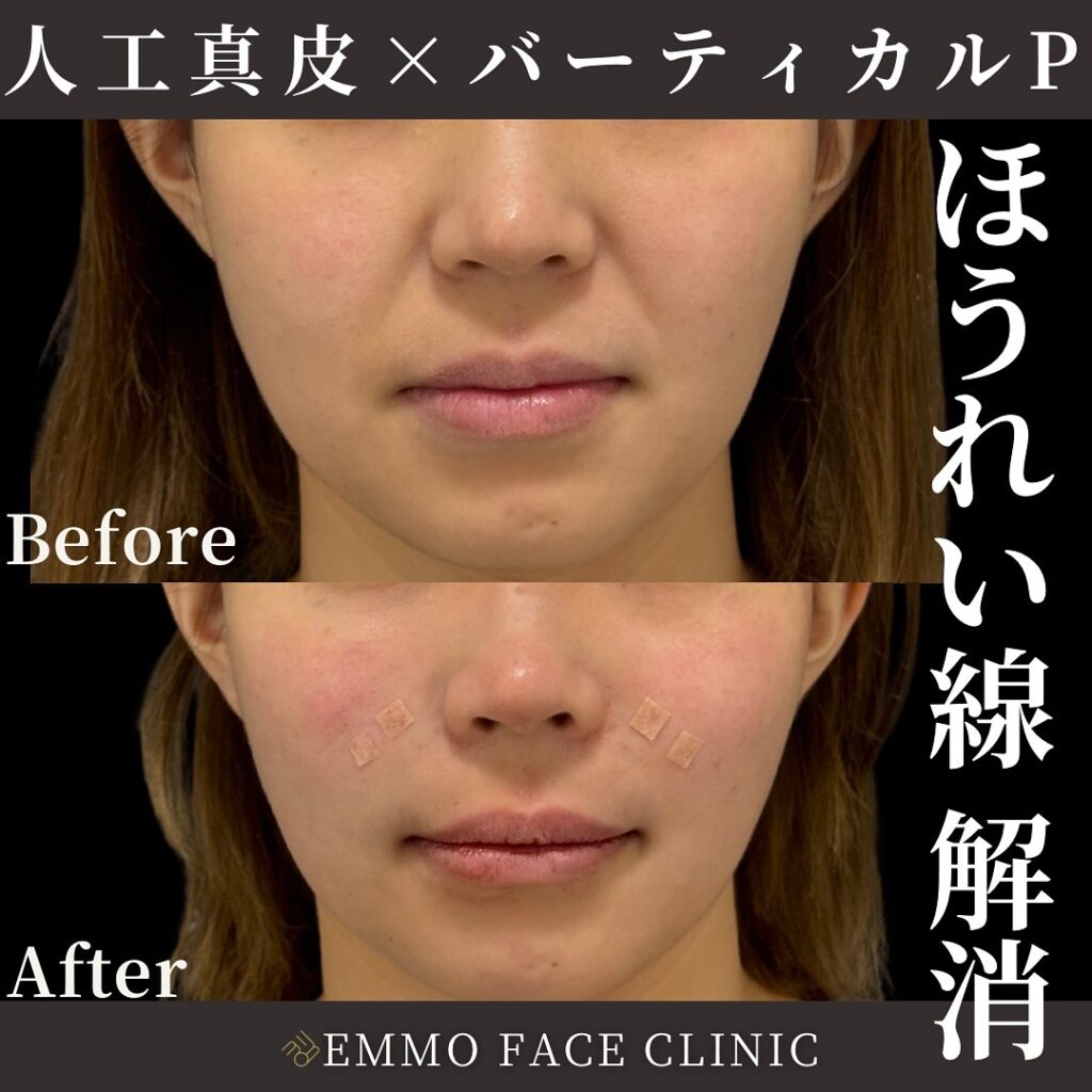 人工真皮とバーティカルリフトプレミアムのビフォーアフター2