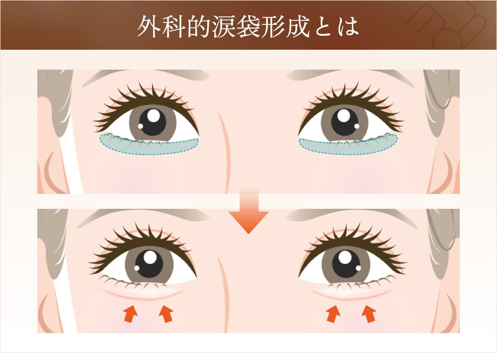 外科的涙袋形成の術後イラスト