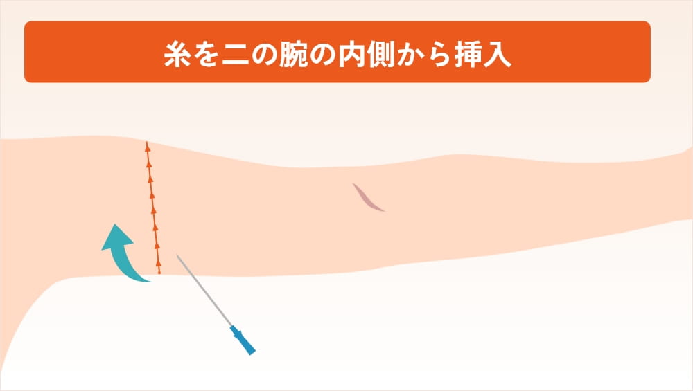 二の腕の内側から糸を挿入しているイラスト