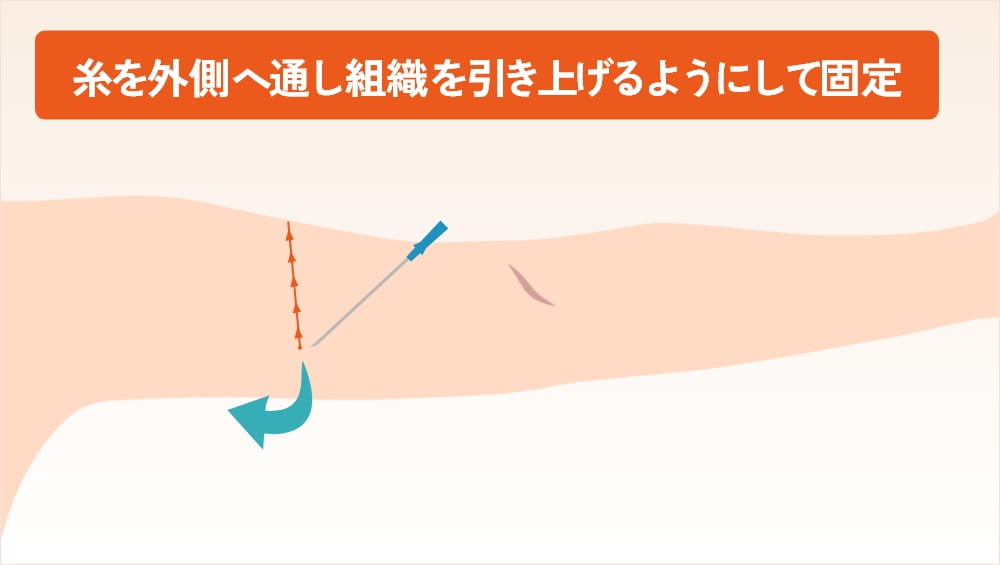 二の腕の外側へ糸を通しているイラスト