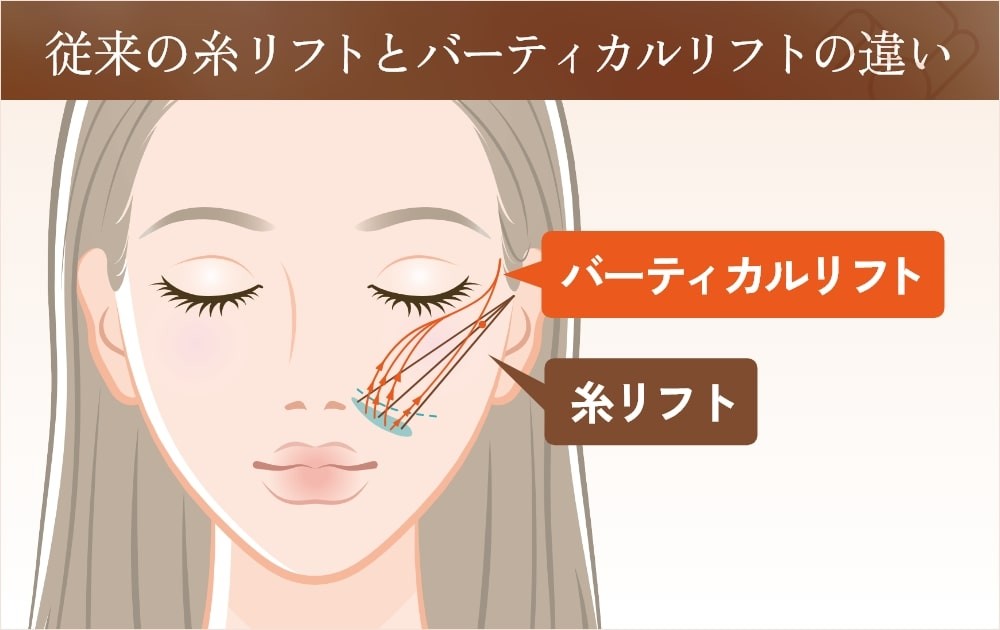従来の糸リフトとバーティカルリフトの違い