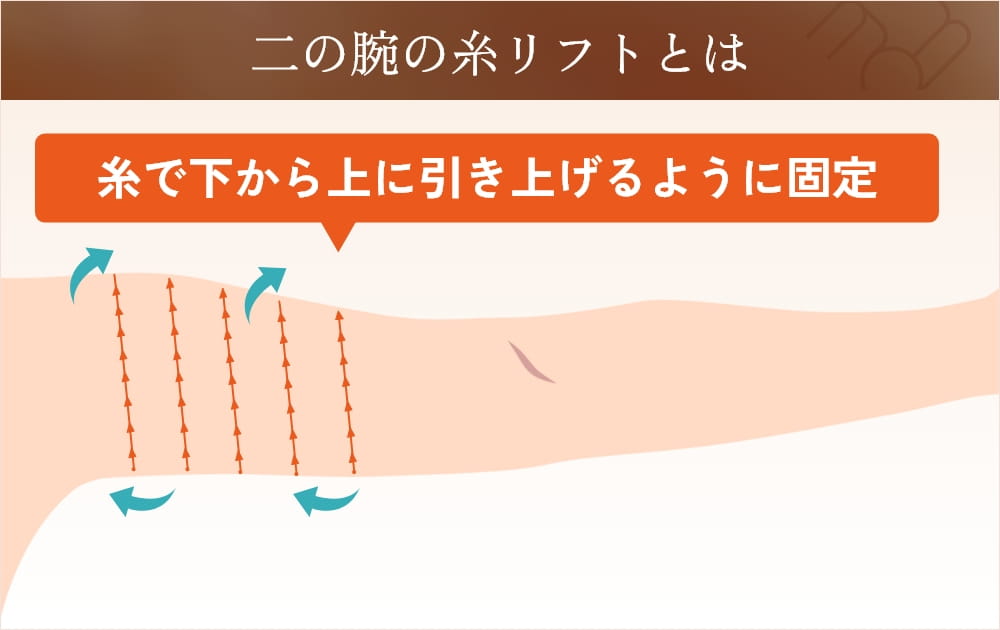 二の腕糸リフトの挿入位置