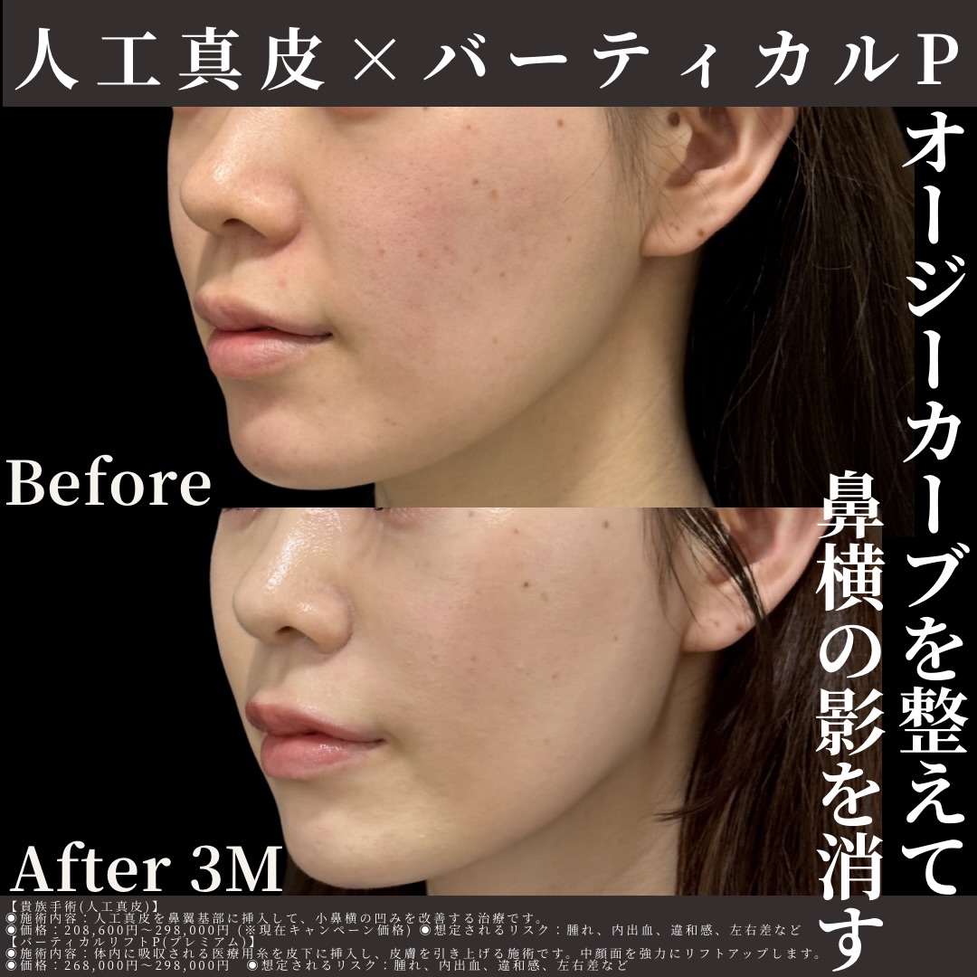 人工真皮×バーティカルリフトプレミアム