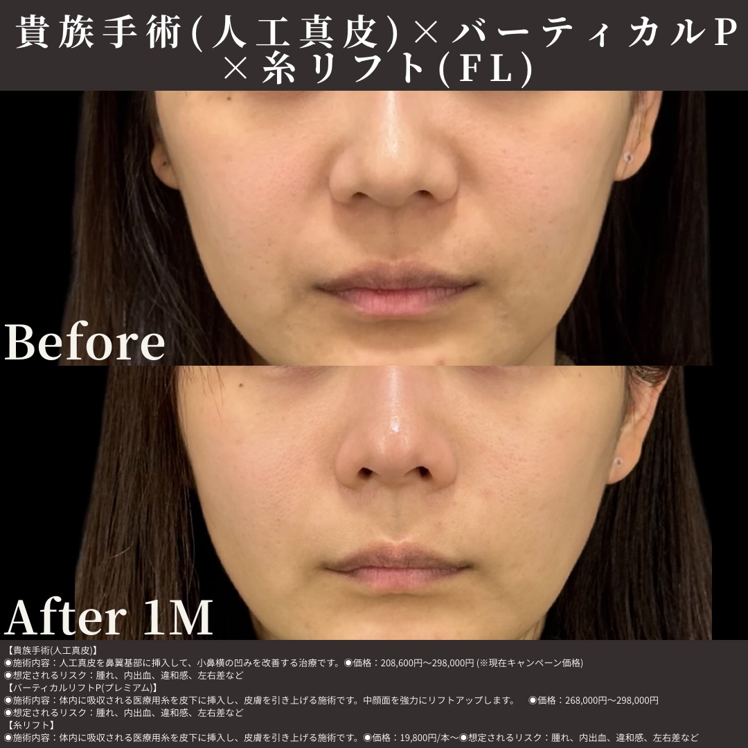人工真皮×バーティカルリフトプレミアム