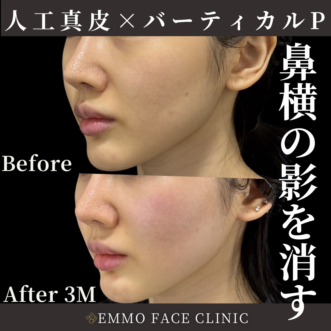 人工真皮×バーティカルリフトプレミアム