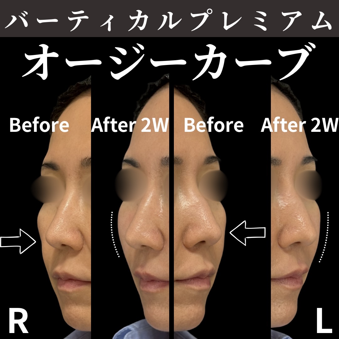 バーティカルリフトプレミアム