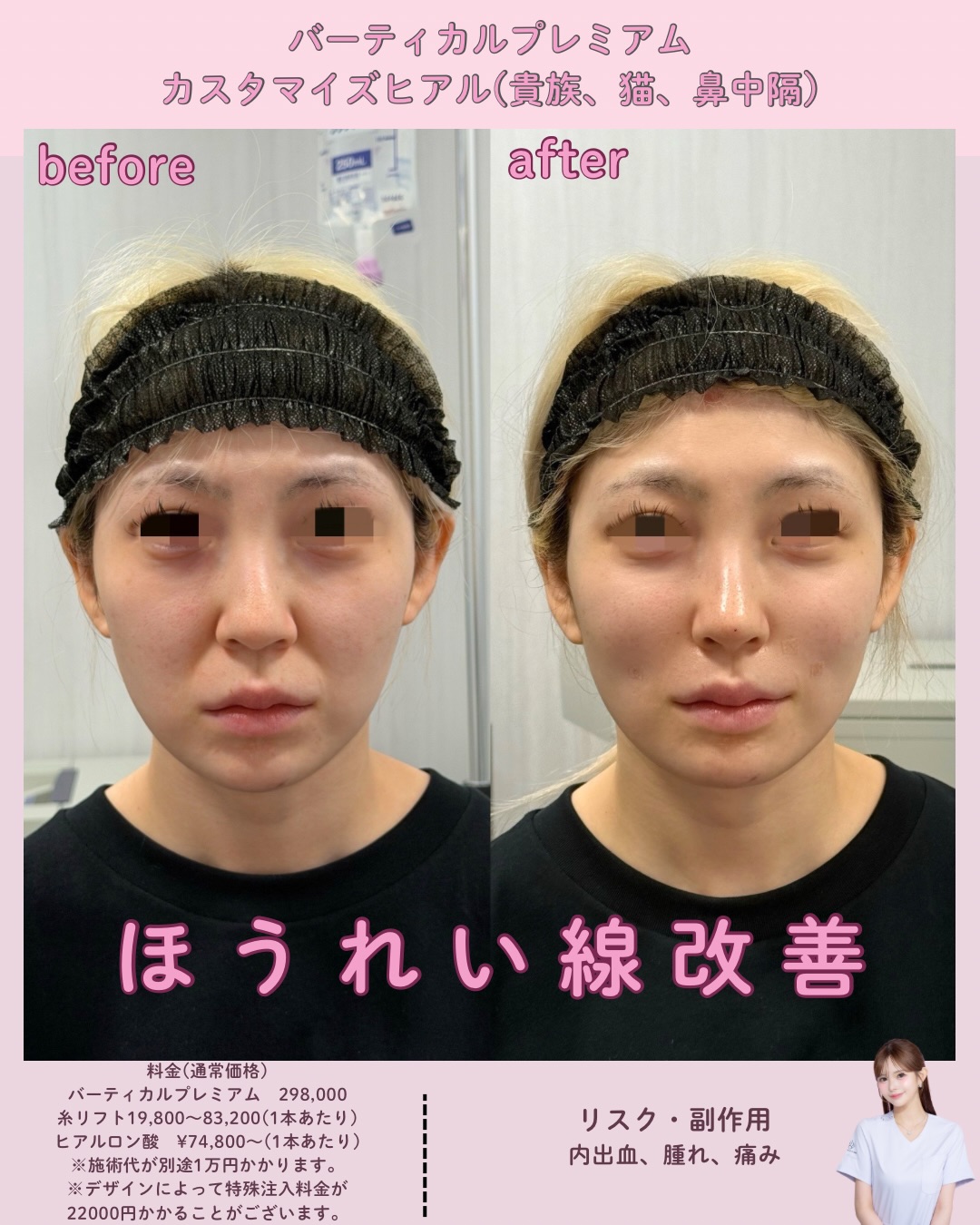 バーティカルリフトプレミアム×ヒアルロン酸