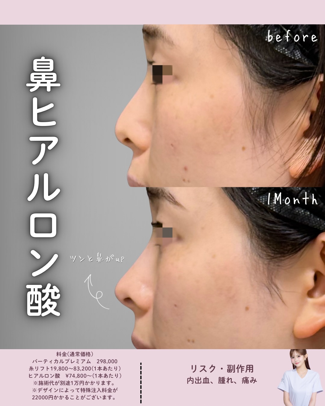 ヒアルロン酸（鼻）
