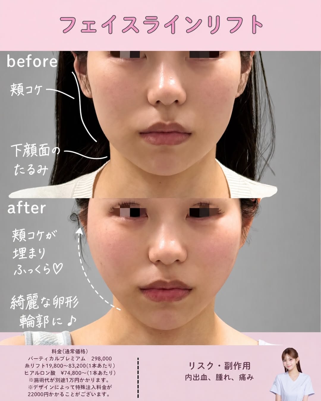 フェイスラインリフト