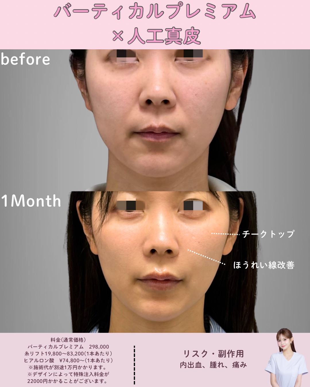 バーティカルリフト×人工真皮