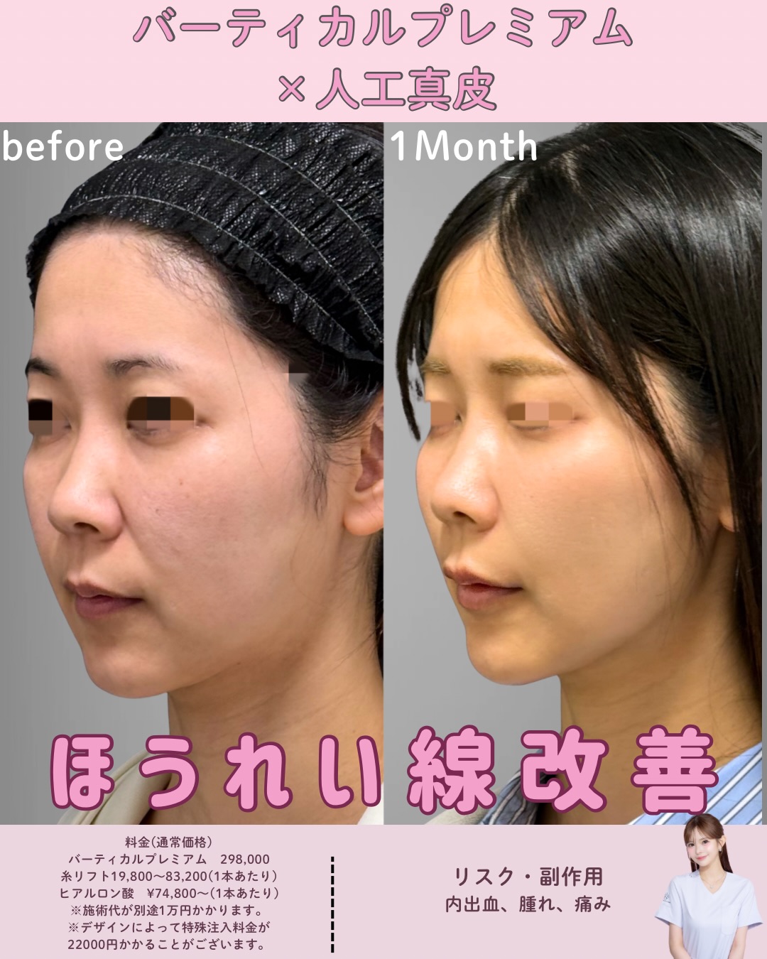 バーティカルリフト×人工真皮