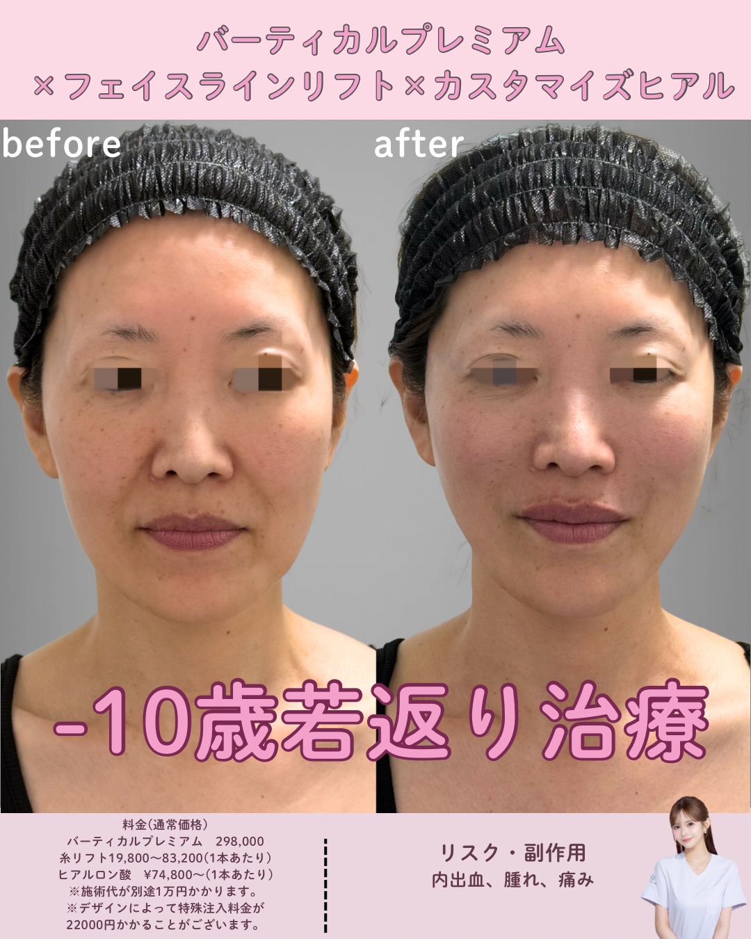 バーティカルリフトプレミアム×糸リフト×ヒアルロン酸