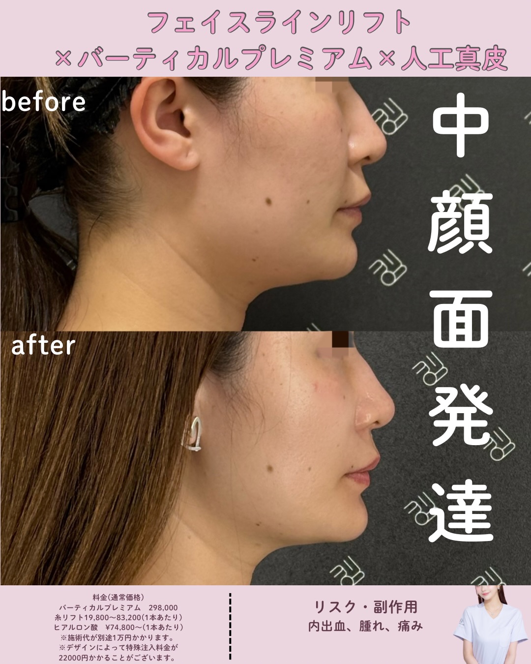 フェイスラインリフト×バーティカルリフトプレミアム×人工真皮