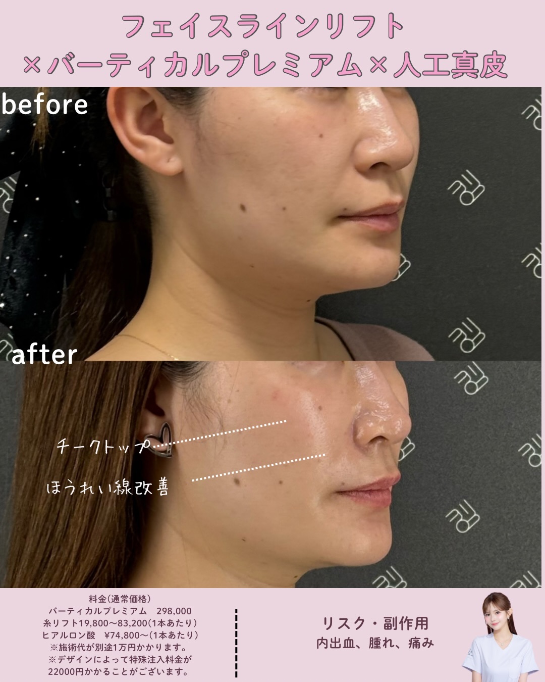フェイスラインリフト×バーティカルリフトプレミアム×人工真皮