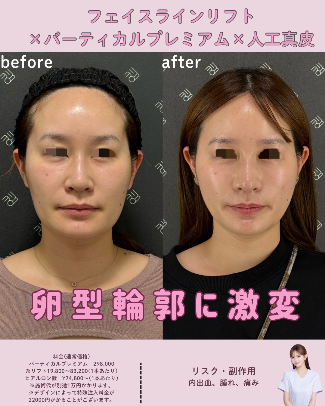 フェイスラインリフト×バーティカルリフトプレミアム×人工真皮