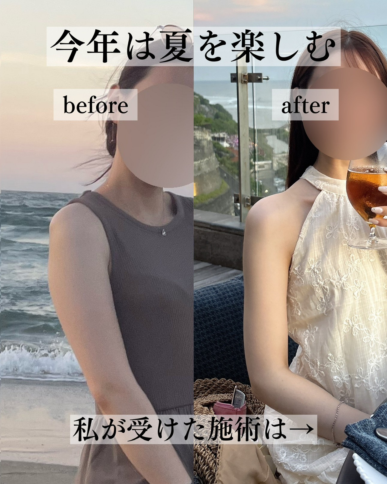 二の腕脂肪吸引ー症例写真