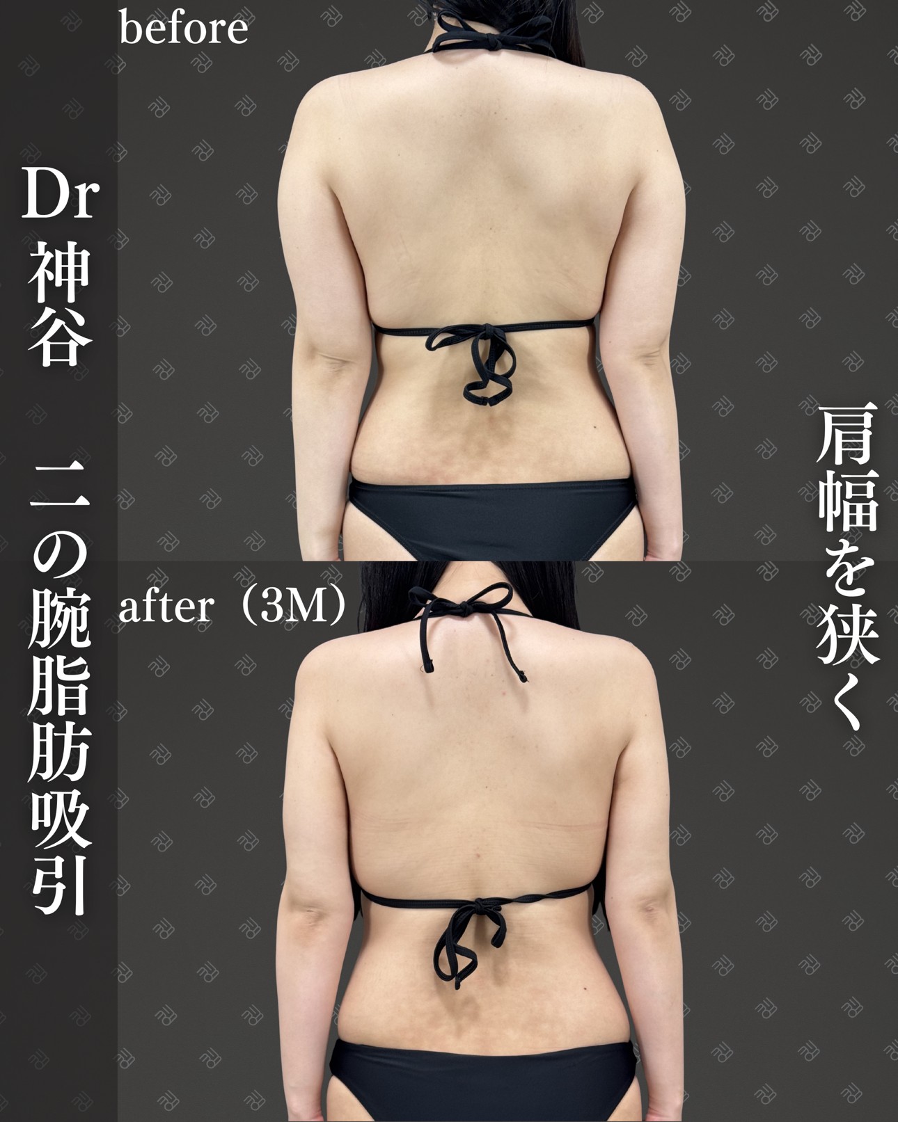 二の腕脂肪吸引ー症例写真