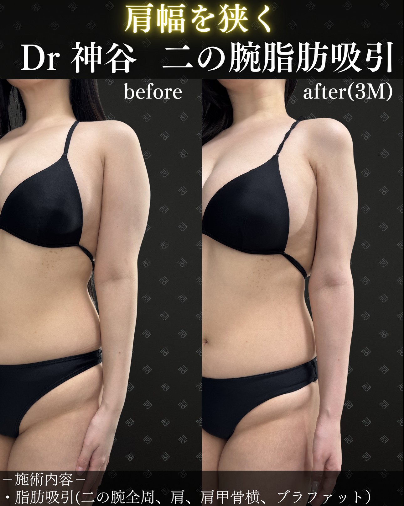 二の腕脂肪吸引ー症例写真