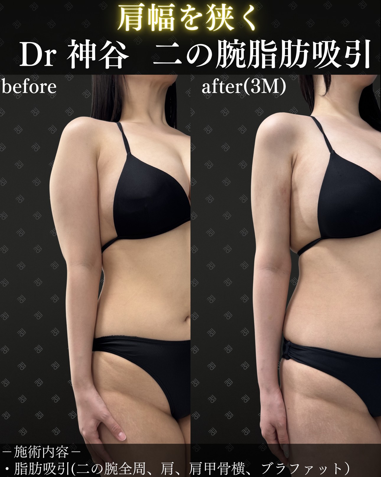 二の腕脂肪吸引ー症例写真